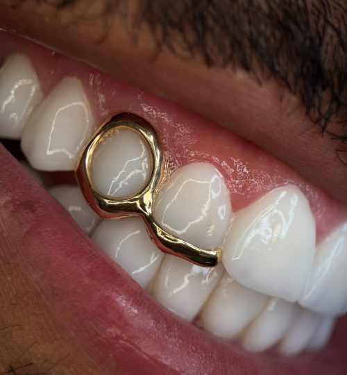 grillz oro 22k para jurgen locadia con ventana y puente hechos a medida en @lallamatattoo mil gr